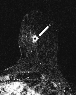 Predicting tumor-positive post-lumpectomy margin risk with breast MRI