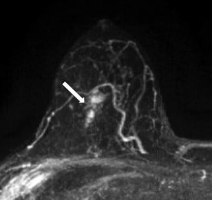 Partnership Brings QuantX Diagnostic AI to More Breast Radiologists