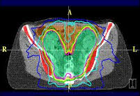 EMBRACE Study Points to Options for Reducing Side Effects After Cervical Cancer Treatment