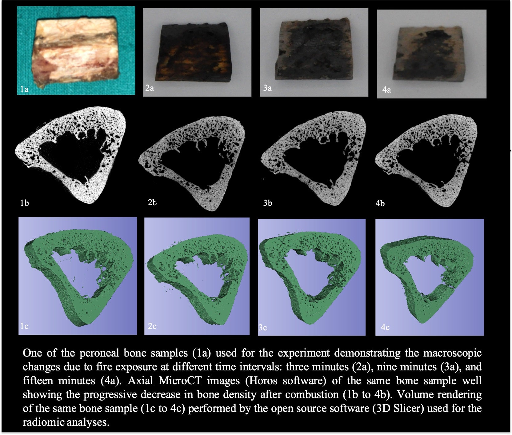 RSNA 2020: Radiomics Aid Forensic Examination of Charred Human Bones