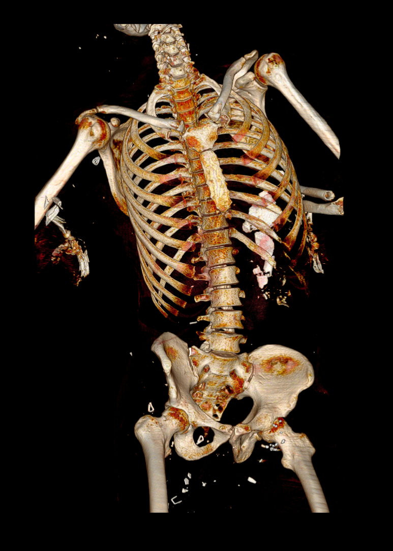 RSNA 2020: Radiomics Aid Forensic Examination of Charred Human Bones