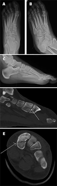 Cross-sectional imaging essential to detecting midfoot fractures