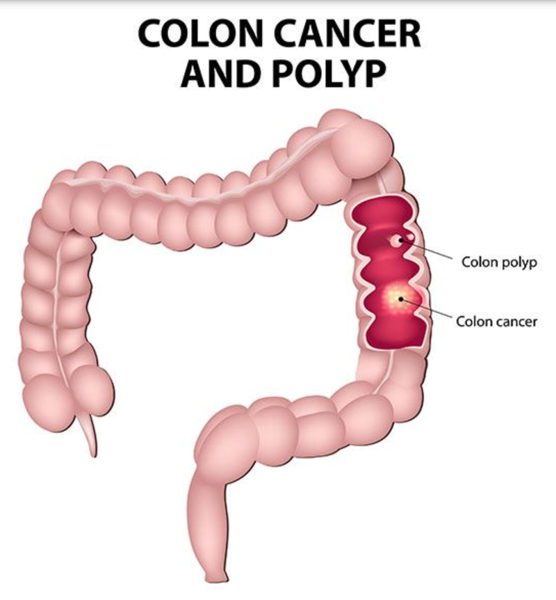 Many Older Female Colorectal Cancer Survivors Have Persistent GI Symptoms