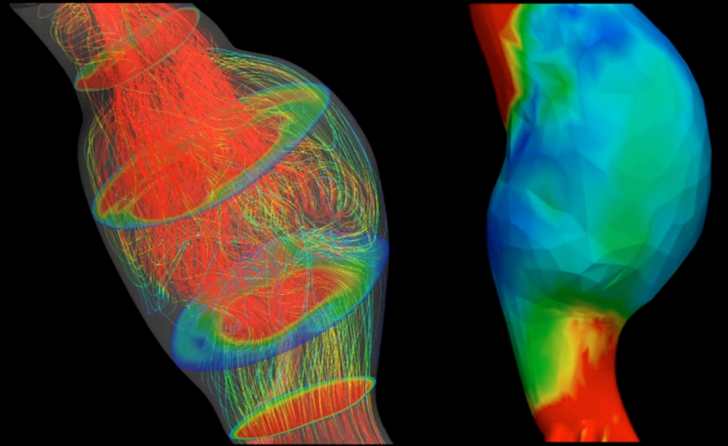 Image-Based Computational Model Predicts Early AAA Rupture