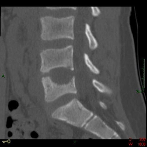 AMA Issues Category III CPT Code for VCF Detection from CT Scan