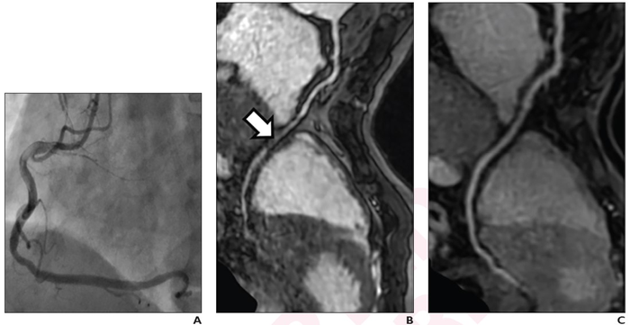 3T Dixon GRE Sequence Outperforms Current Standard for Unenhanced Coronary MRA