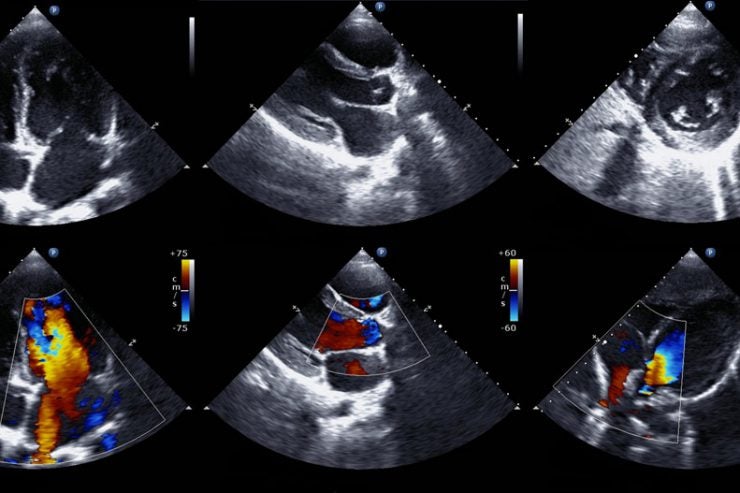 CardioSuite Added to the Eureka Clinical AI Platform