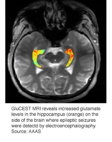 New MRI technique identifies previously undetected epileptic seizure sites
