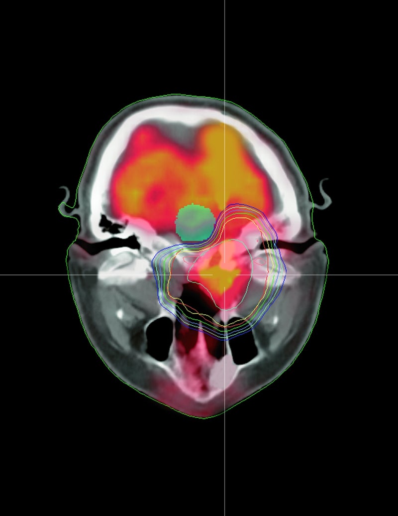 AI Model May Improve Time Efficiency and Standardization in Head and Neck Radiotherapy