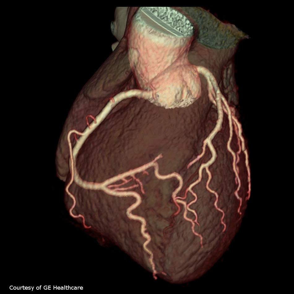 CMS Appropriate Use Criteria for Cardiac Imaging Creates Reimbursement Confusion