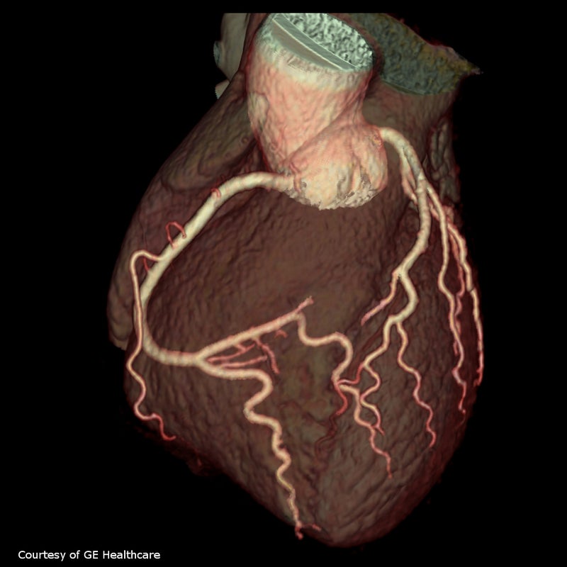 Accurate Measurement of Left Ventricular Function Following Novel Treatment