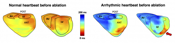 Study: Ultrasound Solves an Important Clinical Problem in Arrhythmia Diagnosis