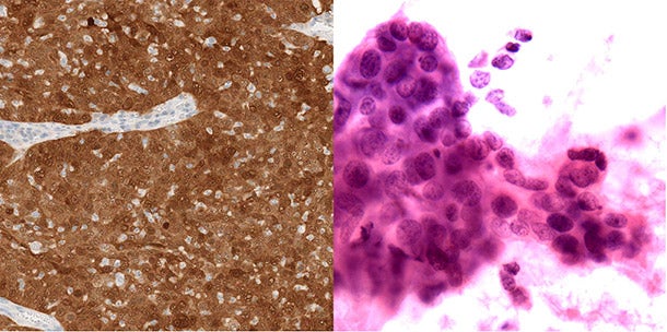 Less Radiation Post-Surgery Prolongs Survival in Some HPV-Related Throat Cancer Patients