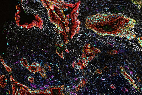 5-Aminolevulinic Acid-Mediated Radiation Therapy Can Reduce Tumor Size