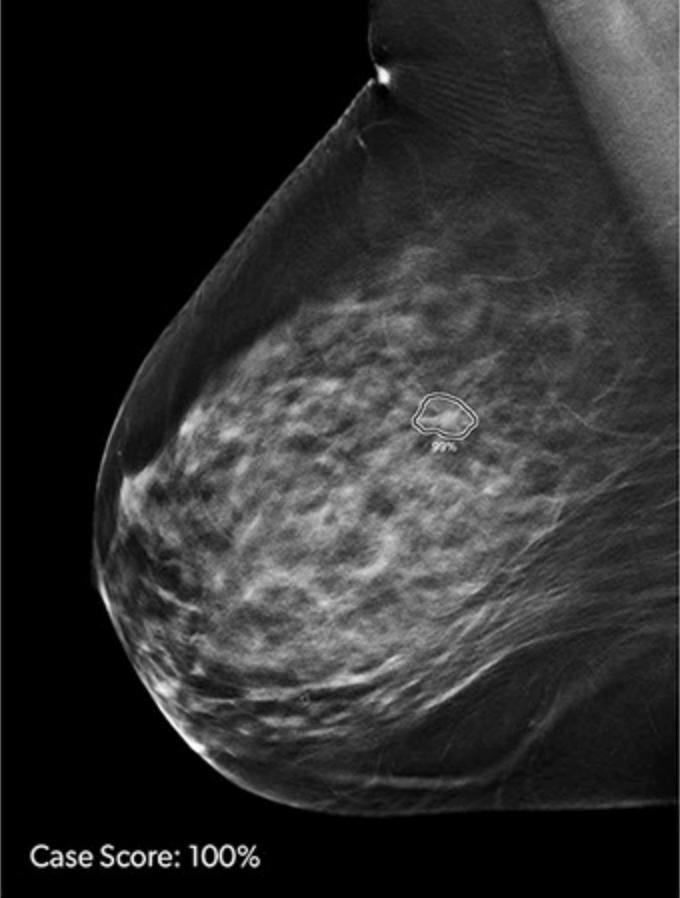 ProFound AI Outperforms Breast Cancer Risk Model in Clinical Study