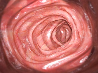 Machine Learning Method Identifies Precancerous Colon Polyps