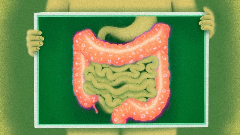 Researchers Identify Mechanism That Causes Colitis in Patients Receiving Immunotherapy