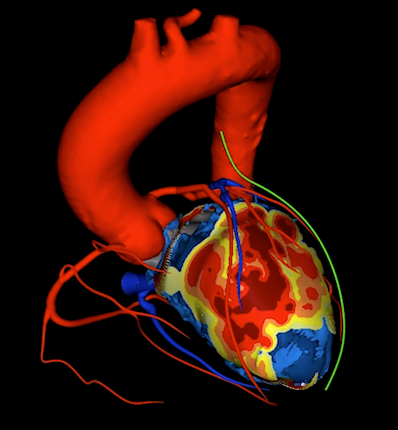 Varian Nets IDE to Start Cardiac Radioablation Trial