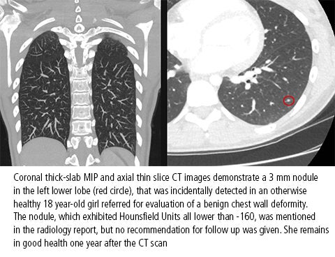 Advice from SPR about pediatric incidental pulmonary nodules