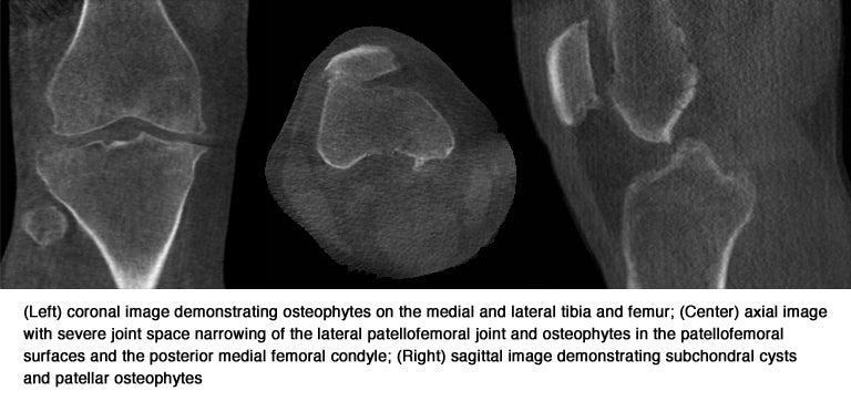 Standing CT to diagnose knee osteoarthritis: Better performance than an x-ray, significantly less expensive than MRI