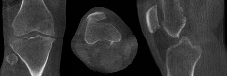 Quadriceps Grafts May Be Superior to Repair ACL in Adolescents