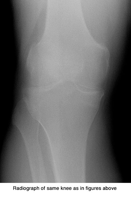 Standing CT to diagnose knee osteoarthritis: Better performance than an x-ray, significantly less expensive than MRI