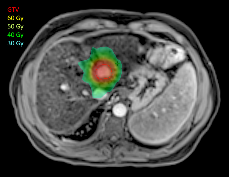Radiation Added to Systemic Therapy Extends Survival in Advanced Liver Tumor Patients