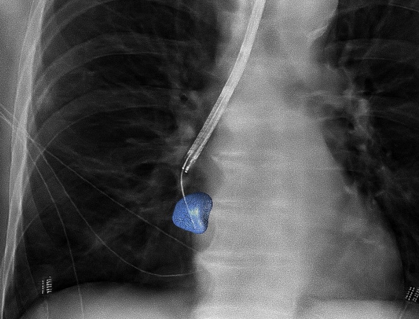 Study Shows 90% Diagnostic Accuracy of Lung Nodules with Philips Technology