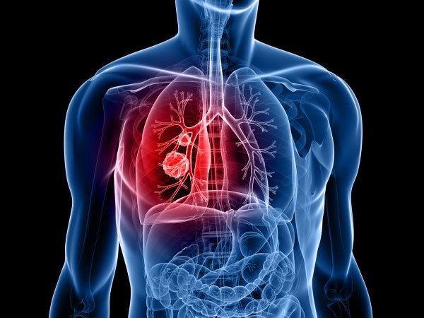 Brown University Study Reveals Additional Cancer Detection Through Lung Cancer CT Scans