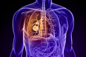 Expanding Lung Cancer Screening to Never-Smokers: Promising Developments