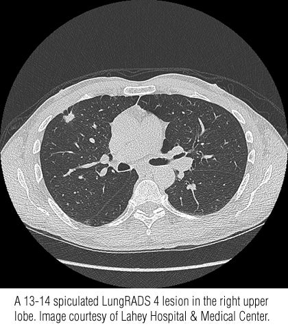 Lung Cancer Screening Rates Worst Among Commercially Insured Patients