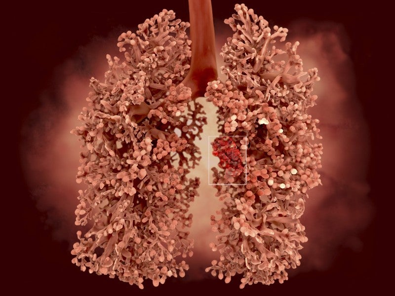 AMA Resolution Supports Expanded Low-Dose CT Screening to Detect Lung Cancer and Heart Risk