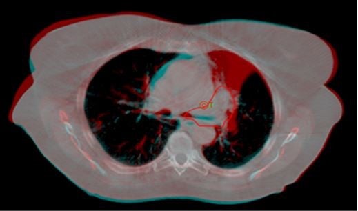 Study Supports Use of IMRT Over 3D-CRT for Lung Cancer