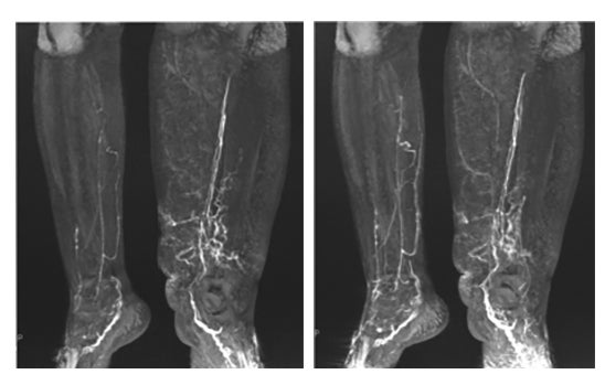 Using MR lymphangiography for lymphedema microsurgical planning