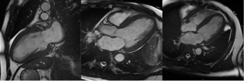 CMR Shows Myocardial Fibrosis In Patients With Hypertension Is Linked To Worse Outcomes