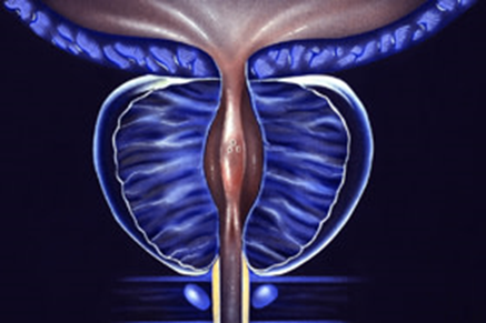 Investigational Therapeutic Radiopharmaceutical Shows Promise in Treating Prostate Cancer