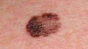 New Immunotherapy Strategy for Enhancing Melanoma Treatment