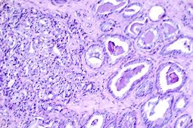 Research Results Show 20% Improved Prostate Cancer Detection on Biparametric MRI Using AI