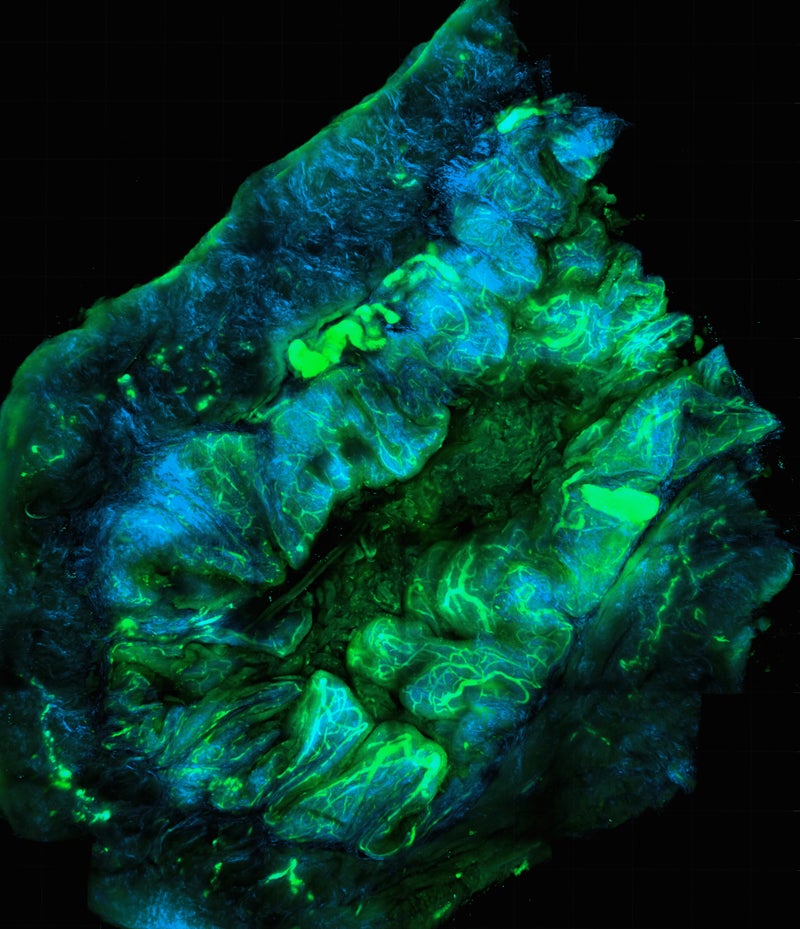 2D and 3D Maps Provide New Insight Into Colorectal Cancer