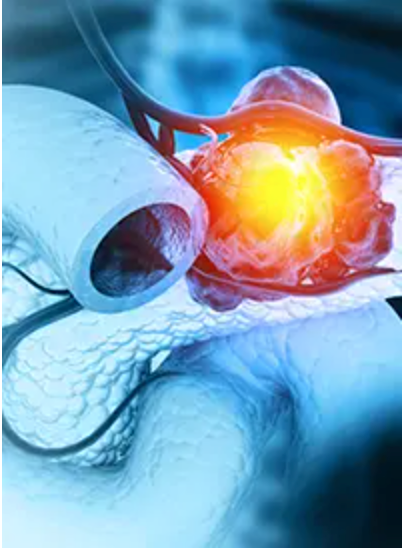 COMPETE Trial Data Shows 177Lu-edotreotide Improves Progression-Free Survival in SSTR-GEP-NETs