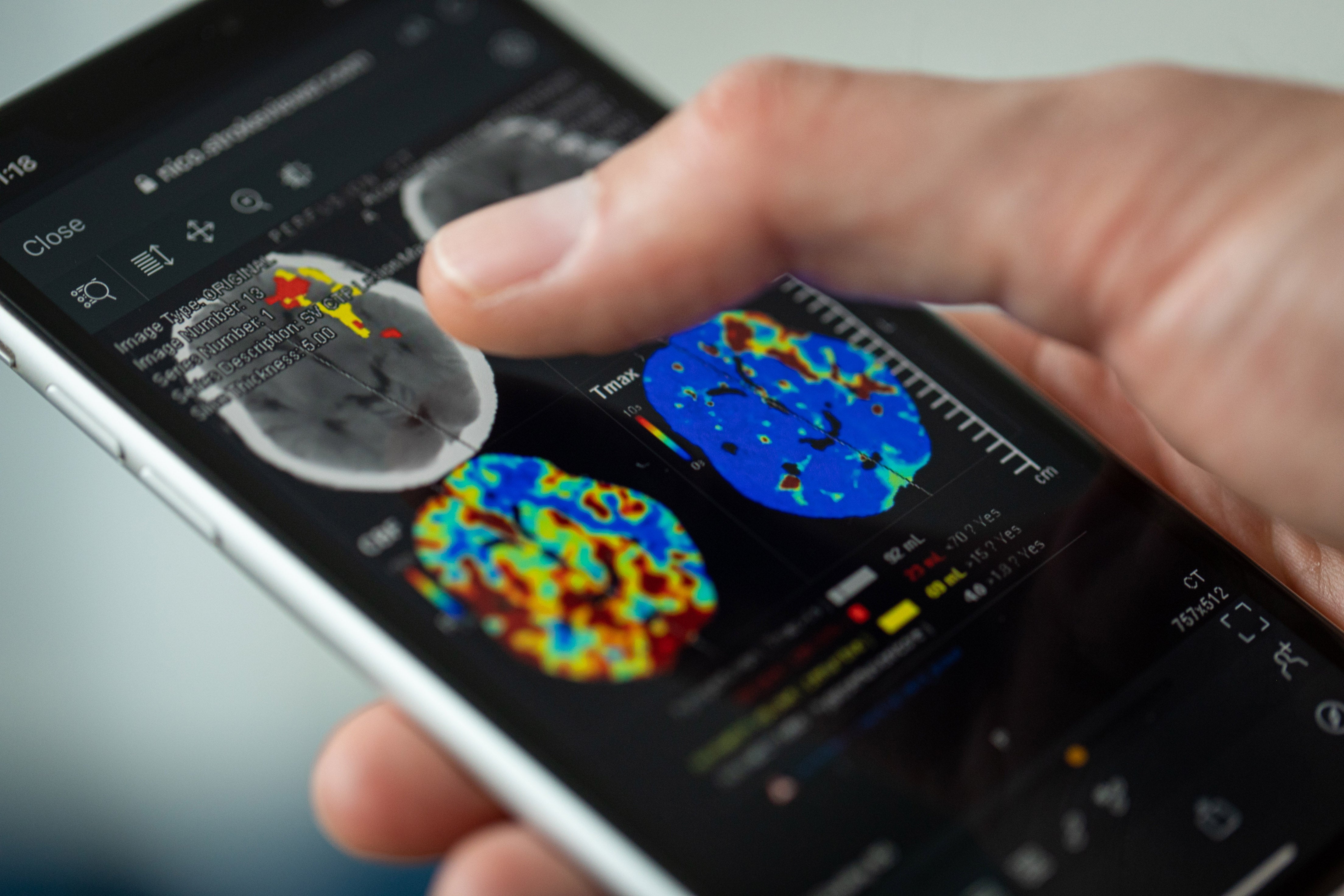 Philips’ Partnership Accelerates Stroke Diagnosis and Treatment