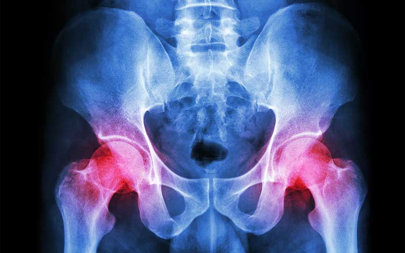 Crowdsourcing Effort Seeks Machine-learning Tools to Automate Rheumatoid Arthritis Assessment