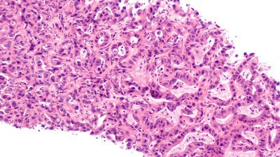 Drug Shows Promise in Advancing Potential of BNCT