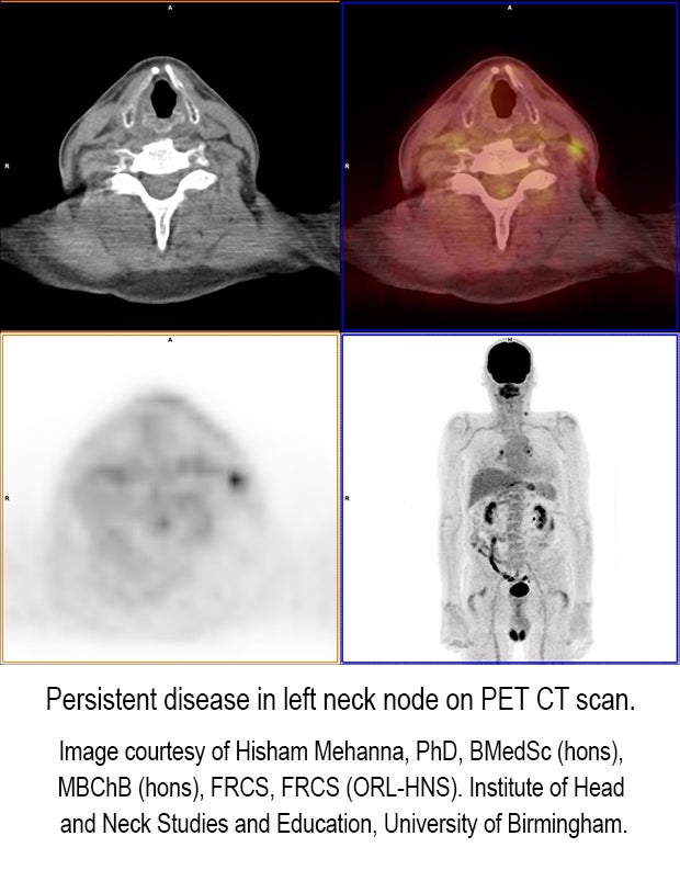 U.K. clinical trial validates PET-CT surveillance for patients with advanced head/neck cancer