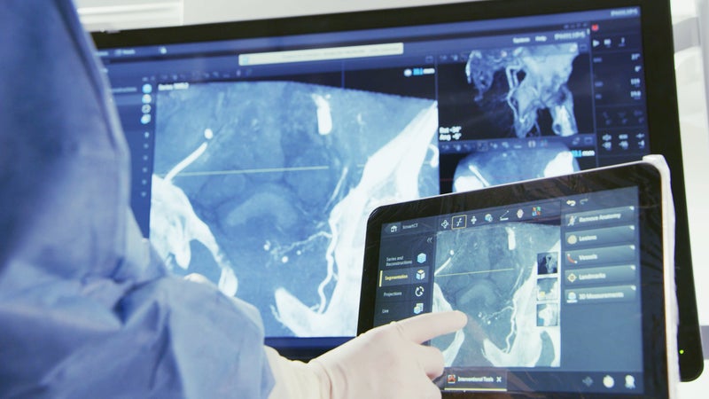 Intraoperative 3D Imaging Improves Accuracy of Pedicle Screw Placement in Spine Surgery
