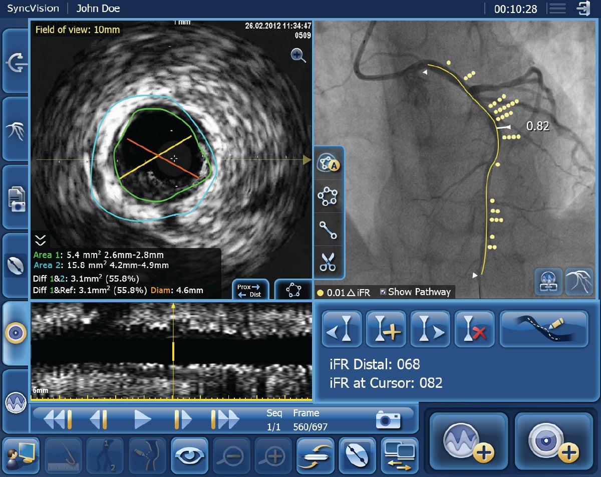 New Study Assesses Innovative Procedure to Open Blocked Coronary Arteries