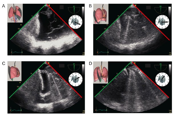 Diagnosing hypoxia rapidly at bedside with transesophageal lung ultrasonography