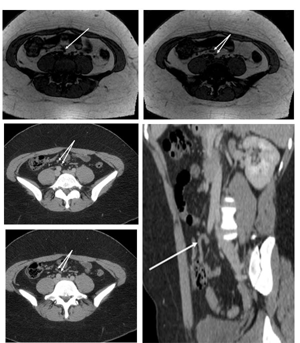 Clinical implications of non-visualization of appendix of pregnant women with appendicitis symptoms