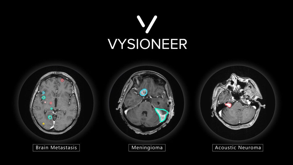 FDA Clears Tumor Auto-contouring Solution for Radiation Therapy