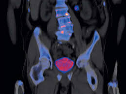 Gene Classifier Tests May Influence Prostate Cancer Treatment Decisions Despite Lack of Long-Term Outcomes Evidence